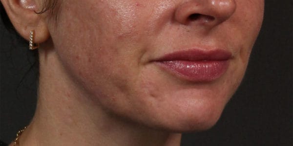 Before and after photos - Address Unwanted Acne