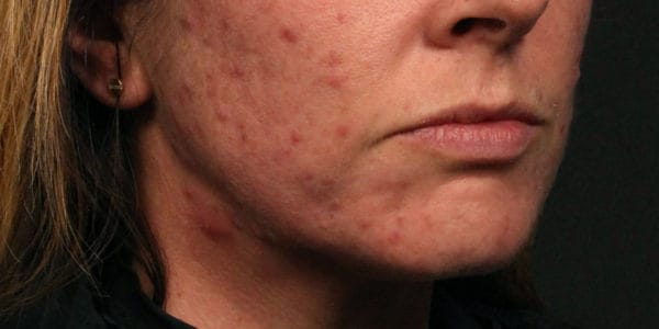 Before and after photos - Address Unwanted Acne