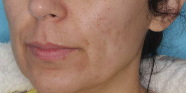 Before and after photos - Clear Cystic Acne & Scarring