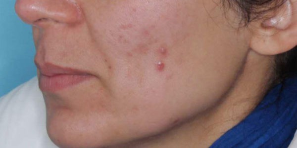 Before and after photos - Clear Cystic Acne & Scarring