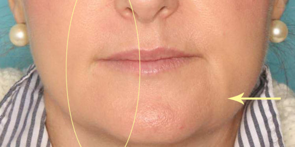 Before and after photos - Lift Sagging Skin on the Face