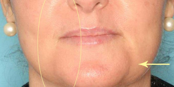 Before and after photos - Lift Sagging Skin on the Face