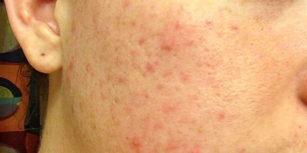 Before and after photos - Eliminate Unwanted Acne