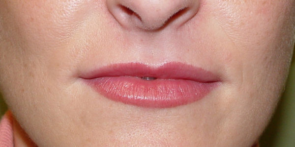 Before and after photos - Plump Up Thin Lips