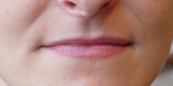 Before and after photos - Plump Up Thin Lips