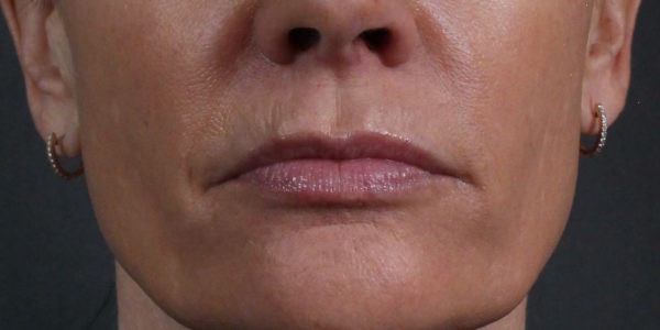 Before and after photos - Get Rid of Fine Lines Around the Lips