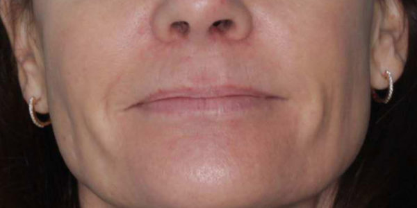 Before and after photos - Get Rid of Fine Lines Around the Lips