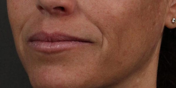 Before and after photos - Eliminate Lines Around The Mouth