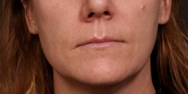 Before and after photos - Erase Unwanted Lines Around Mouth