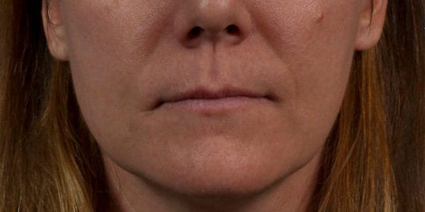 Before and after photos - Erase Unwanted Lines Around Mouth