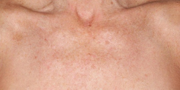 Before and after photos - Treat Uneven Skin Tone and Fine Lines & Wrinkles