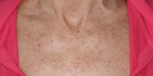 Before and after photos - Treat Uneven Skin Tone and Fine Lines & Wrinkles