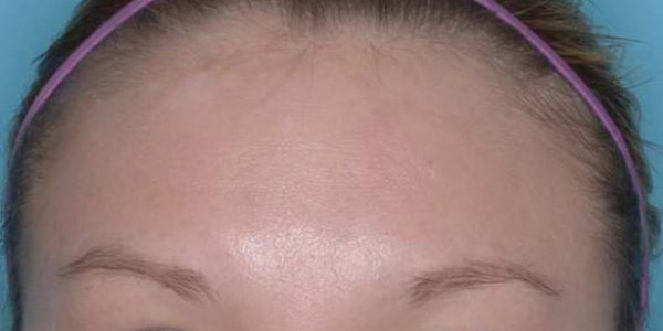 Before and after photos - Even Up Skin Tone, Erase Fine Lines and Wrinkles and Remove Unwanted Brown Spots
                                         