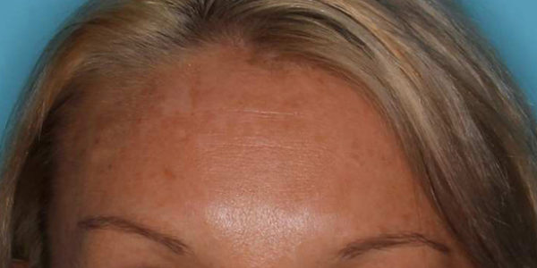 Before and after photos - Even Up Skin Tone, Erase Fine Lines and Wrinkles and Remove Unwanted Brown Spots
                                         