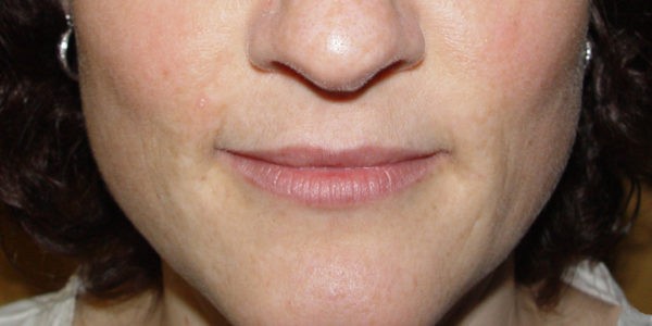 Before and after photos - Reduce Freckling Caused by Exposure to the Sun