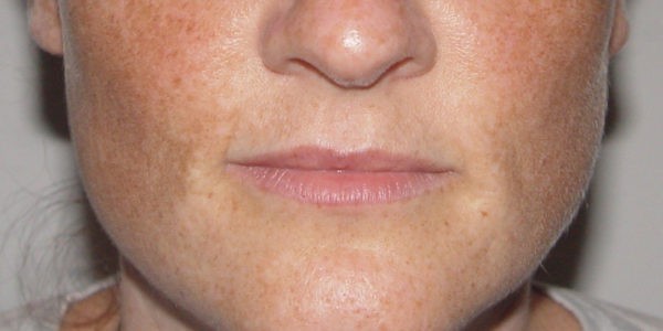 Before and after photos - Reduce Freckling Caused by Exposure to the Sun