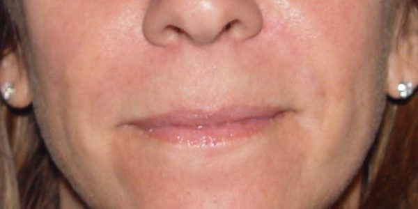 Before and after photos - Erase Unwanted Lines Around Mouth