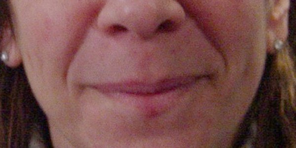 Before and after photos - Erase Unwanted Lines Around Mouth