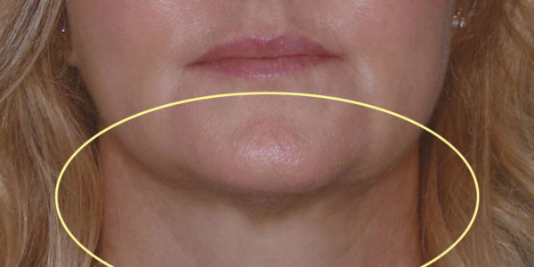 Before and after photos - Remove Fat From Under Chin