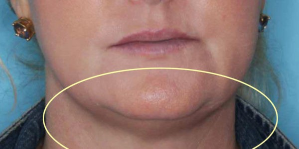 Before and after photos - Remove Fat From Under Chin