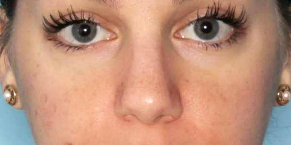 Before and after photos - Create Longer, Thicker, Darker Lashes