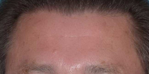 Before and after photos - Erase Lines on Forehead