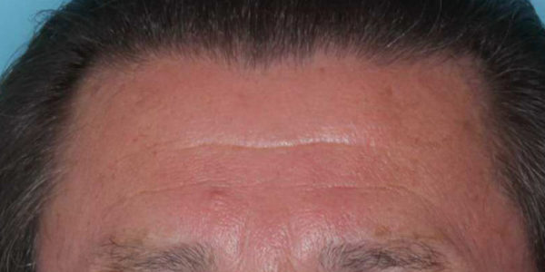 Before and after photos - Erase Lines on Forehead