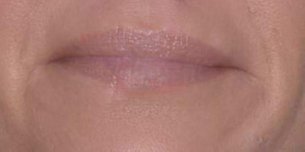 Before and after photos - Restore Volume to Thinning Lips and Erase Fine Lip Lines