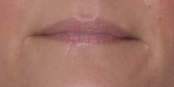 Before and after photos - Restore Volume to Thinning Lips and Erase Fine Lip Lines