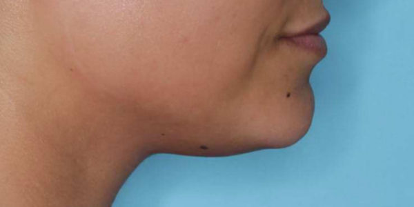 Before and after photos - Tone the Skin Under Chin