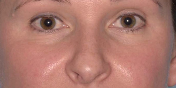 Before and after photos - Correct Uneven Skin Tone