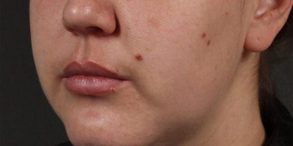 Before and after photos - Improve Uneven Skin Tone