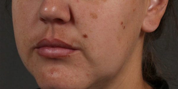 Before and after photos - Improve Uneven Skin Tone