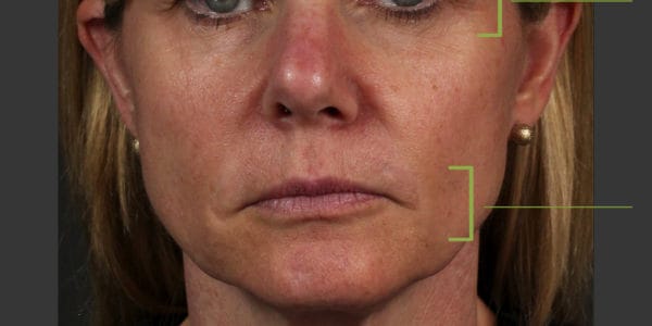 Before and after photos - Rebuild Collagen 