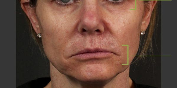 Before and after photos - Rebuild Collagen 