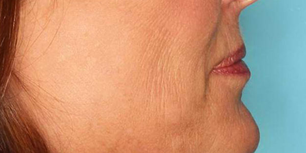 Before and after photos - Lift Sagging Skin in Lower Jowl Area