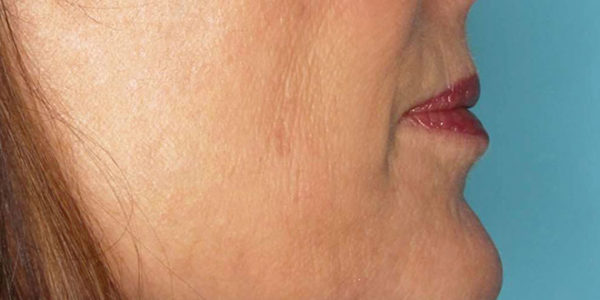 Before and after photos - Lift Sagging Skin in Lower Jowl Area