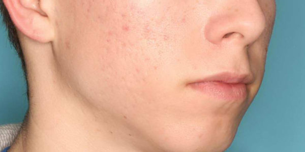 Before and after photos - Treat Unwanted Acne