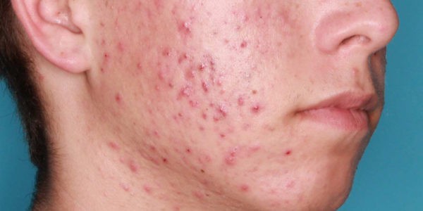 Before and after photos - Treat Unwanted Acne