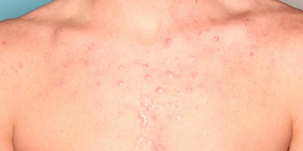 Before and after photos - Treat Stubborn Acne