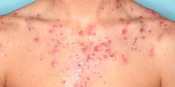 Before and after photos - Treat Stubborn Acne