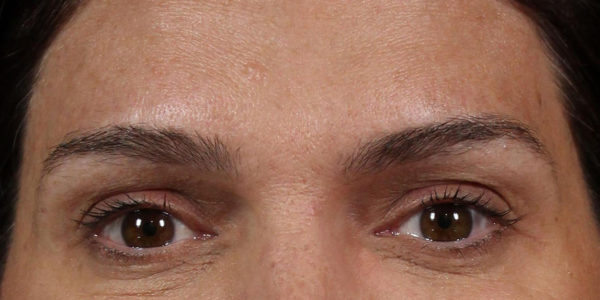 Before and after photos - Erase Heavy Forehead Lines