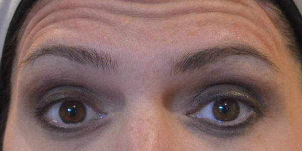 Before and after photos - Erase Heavy Forehead Lines