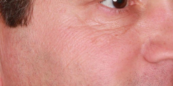 Before and after photos - Smooth Out Crows Feet