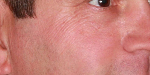 Before and after photos - Smooth Out Crows Feet