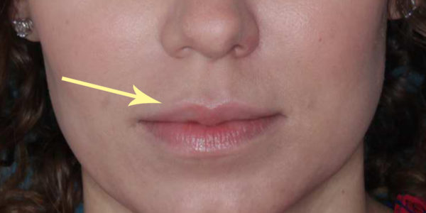 Before and after photos - Add Volume to Thinning Lips