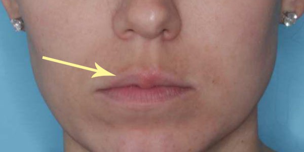 Before and after photos - Add Volume to Thinning Lips