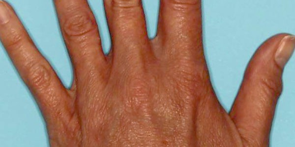 Before and after photos - Younger, fuller looking hands