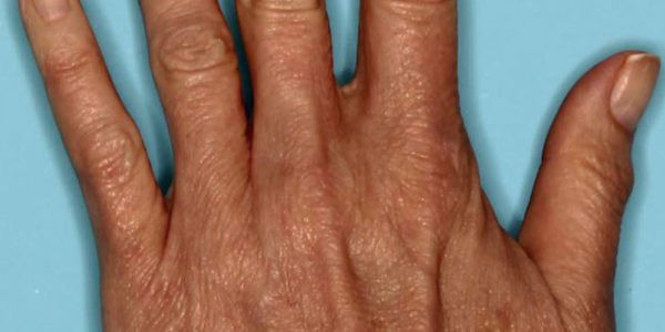 Before and after photos - Younger, fuller looking hands