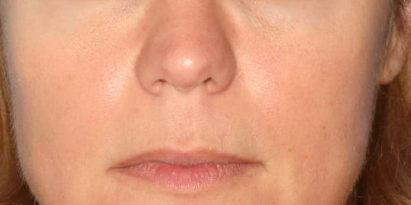 Before and after photos - Fill Under Eye Hollows